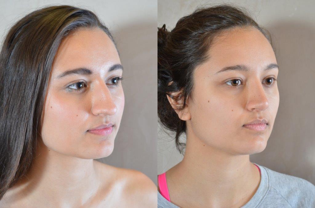Nose Job Before and After