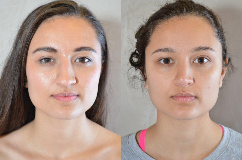 Rhinoplasty Before and After